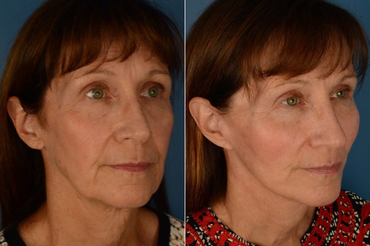 Endoscopic Facelift Before and After Photos in Naples, FL, Patient 21221