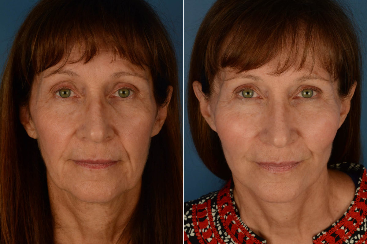 Endoscopic Facelift Before and After Photos in Naples, FL, Patient 21221