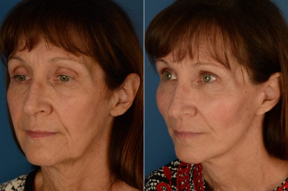 Endoscopic Facelift Before and After Photos in Naples, FL, Patient 21221