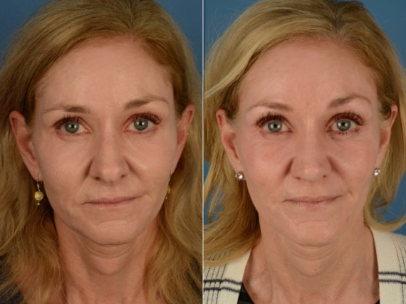 Rhinoplasty Before and After Photos in Naples, FL, Patient 21234