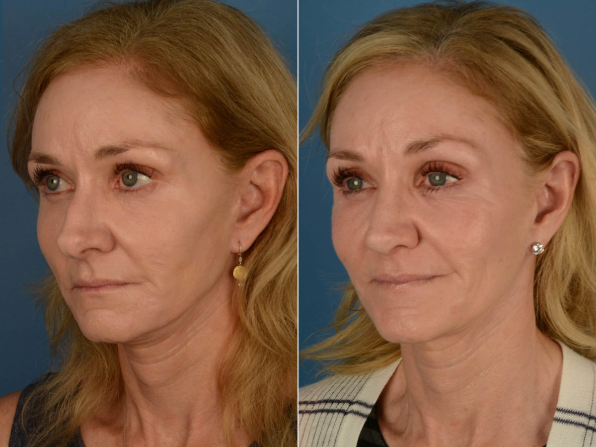 Rhinoplasty Before and After Photos in Naples, FL, Patient 21234