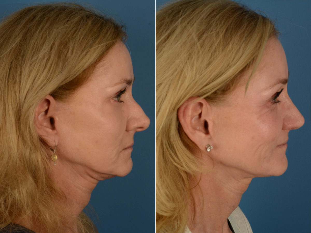 Rhinoplasty Before and After Photos in Naples, FL, Patient 21234