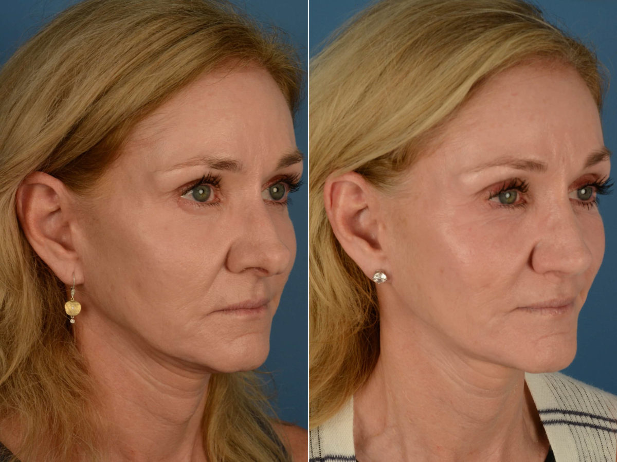 Rhinoplasty Before and After Photos in Naples, FL, Patient 21234