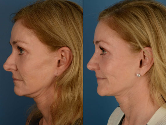 Rhinoplasty Before and After Photos in Naples, FL, Patient 21234