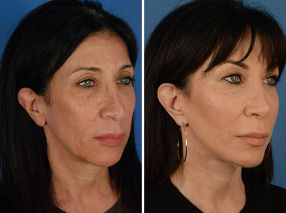 The UpLift™ Lower Face and Neck Lift Before and After Photos in Naples, FL, Patient 12256