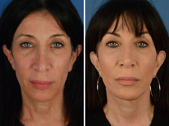 The UpLift™ Lower Face and Neck Lift Before and After Photos in Naples, FL, Patient 12256