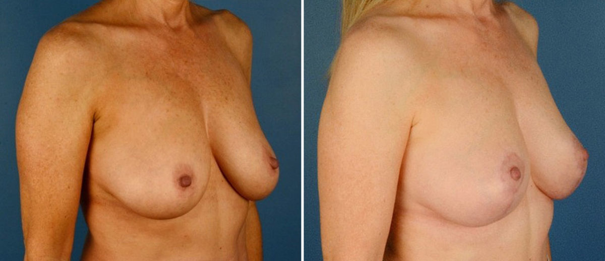 Breast Lift Before and After Photos in Naples, FL, Patient 21087