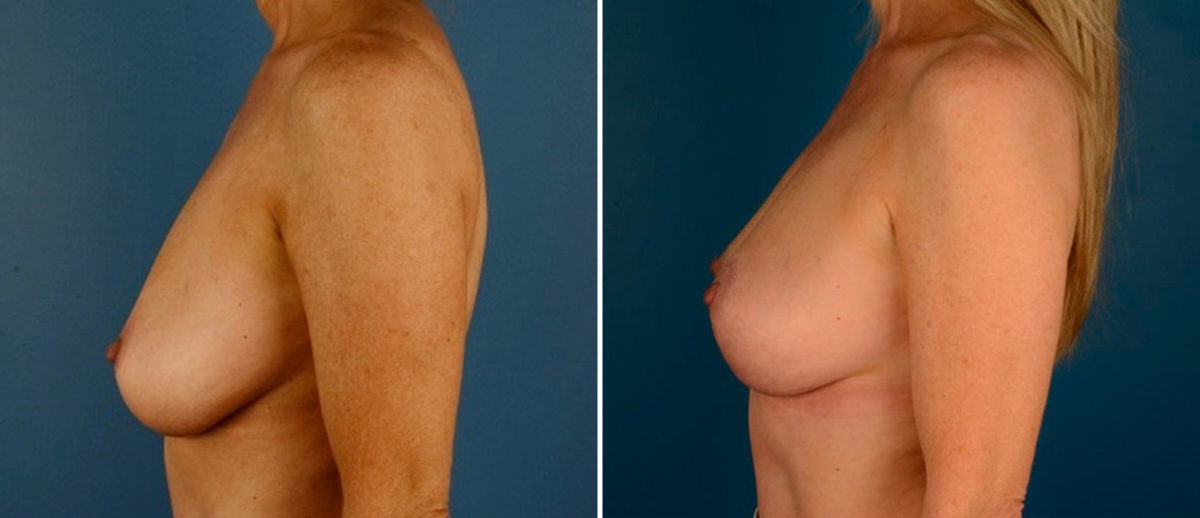 Breast Lift Before and After Photos in Naples, FL, Patient 21087