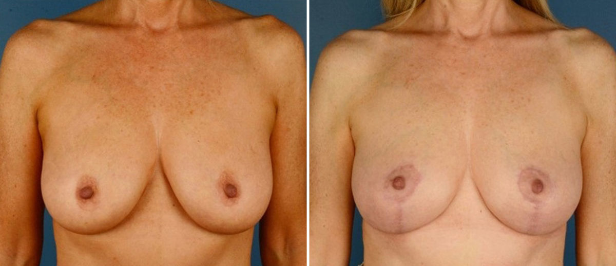 Breast Lift Before and After Photos in Naples, FL, Patient 21087