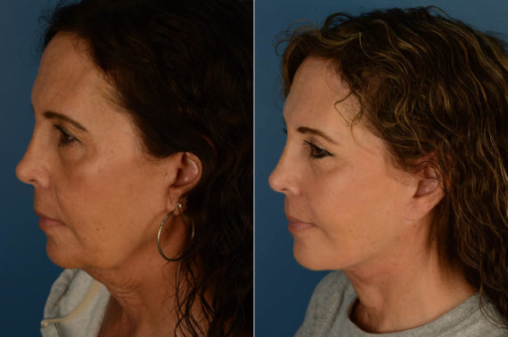 The UpLift™ Lower Face and Neck Lift Before and After Photos in Naples, FL, Patient 21415