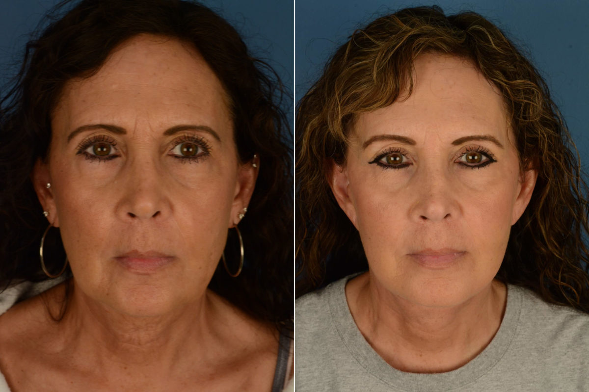 The UpLift™ Lower Face and Neck Lift Before and After Photos in Naples, FL, Patient 21415