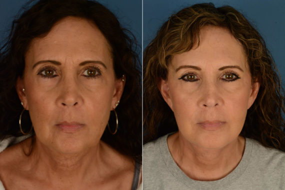 The UpLift™ Lower Face and Neck Lift Before and After Photos in Naples, FL, Patient 21415