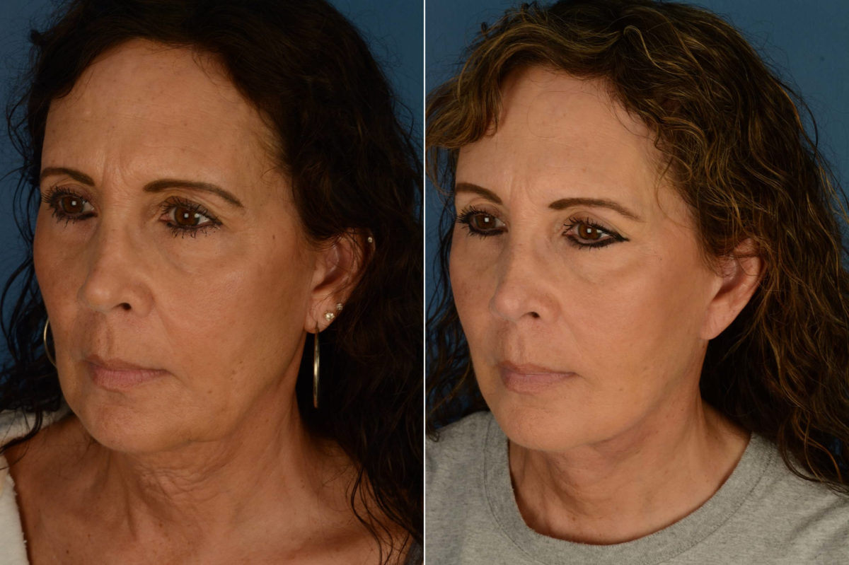 The UpLift™ Lower Face and Neck Lift Before and After Photos in Naples, FL, Patient 21415