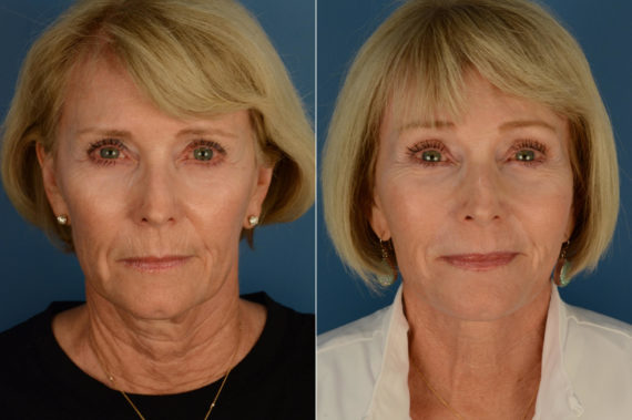 The UpLift™ Lower Face and Neck Lift Before and After Photos in Naples, FL, Patient 21692