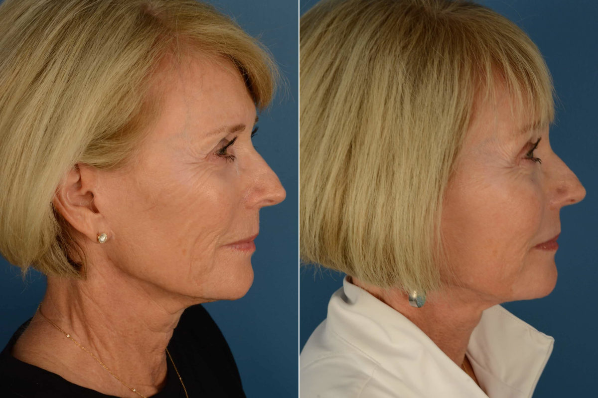 The UpLift™ Lower Face and Neck Lift Before and After Photos in Naples, FL, Patient 21692