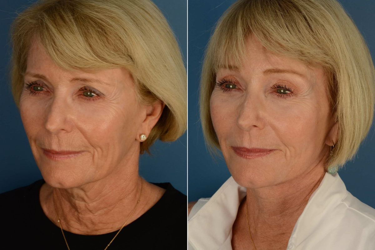 The UpLift™ Lower Face and Neck Lift Before and After Photos in Naples, FL, Patient 21692