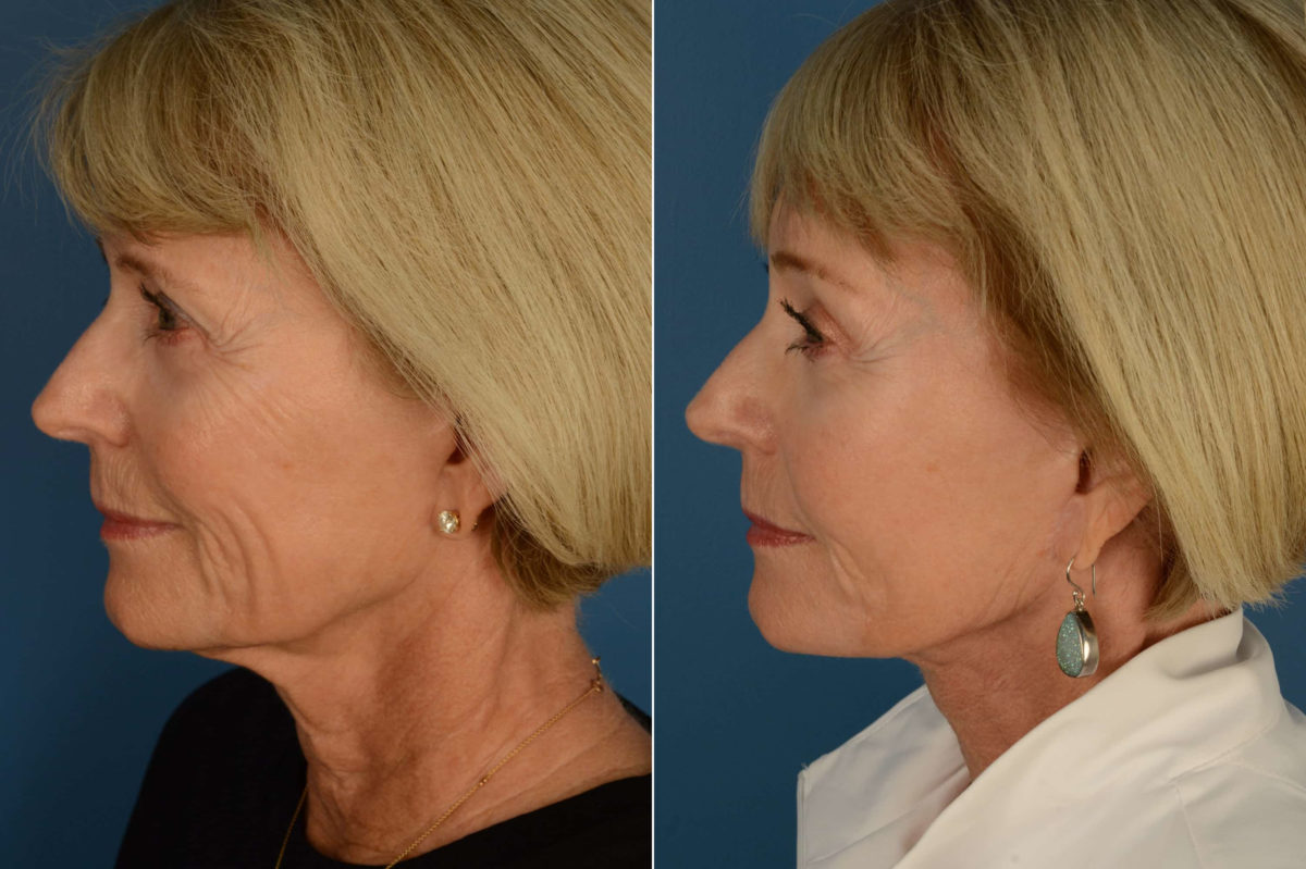 The UpLift™ Lower Face and Neck Lift Before and After Photos in Naples, FL, Patient 21692