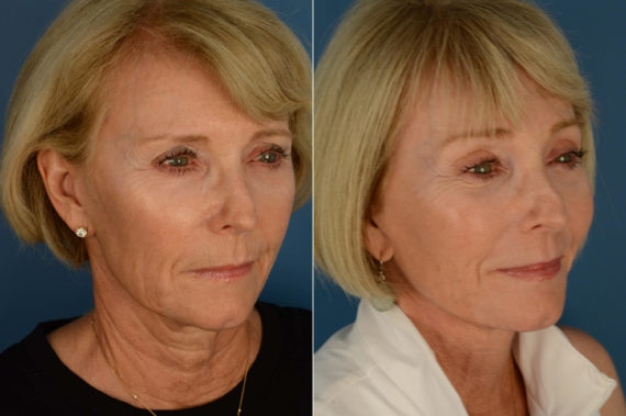 The UpLift™ Lower Face and Neck Lift Before and After Photos in Naples, FL, Patient 21692