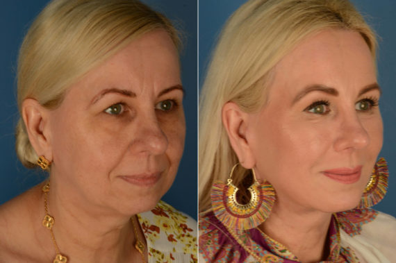 Endoscopic Facelift Before and After Photos in Naples, FL, Patient 21776