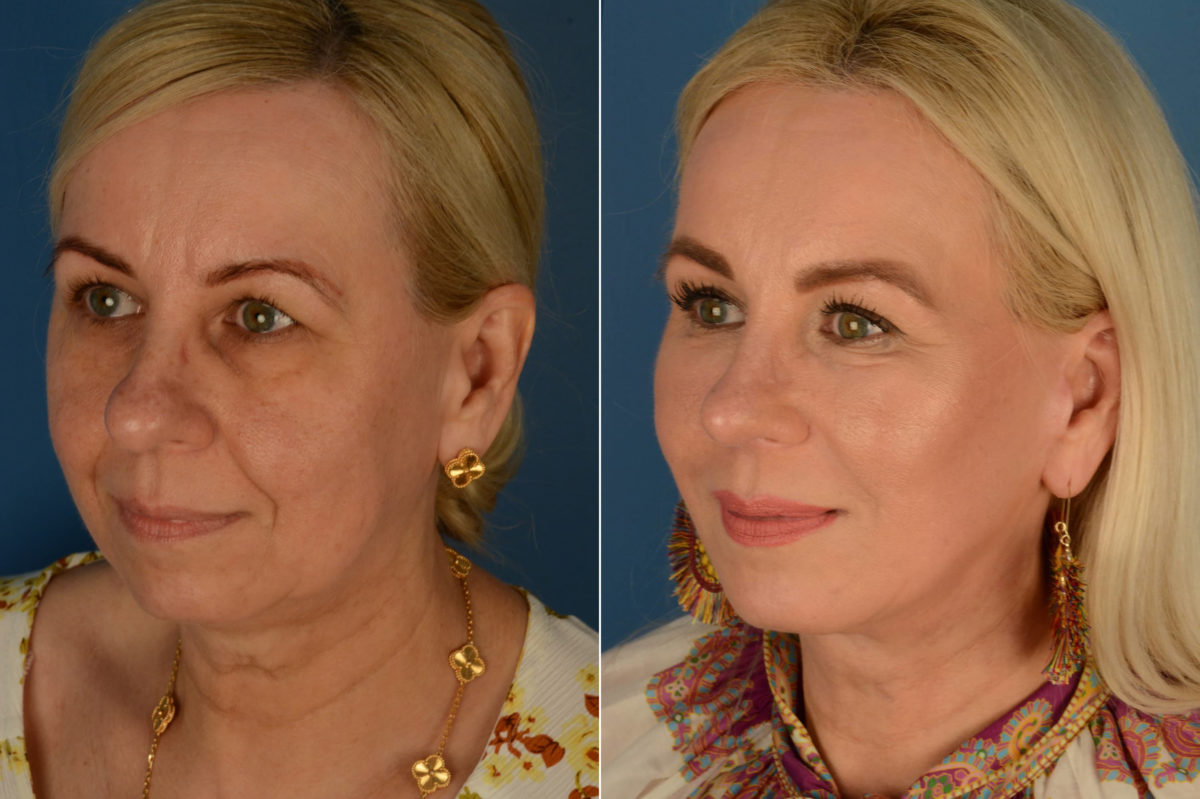 Endoscopic Facelift Before and After Photos in Naples, FL, Patient 21776