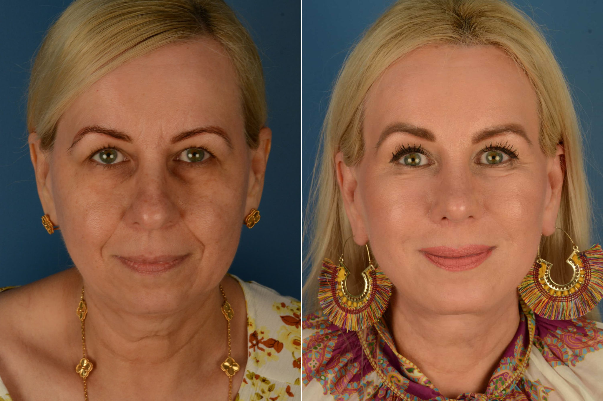Endoscopic Facelift photos Aesthetic Surgery Center
