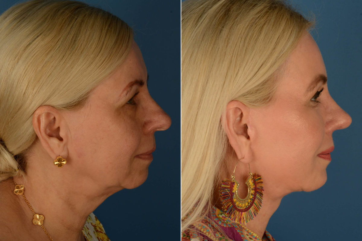Endoscopic Facelift Before and After Photos in Naples, FL, Patient 21776