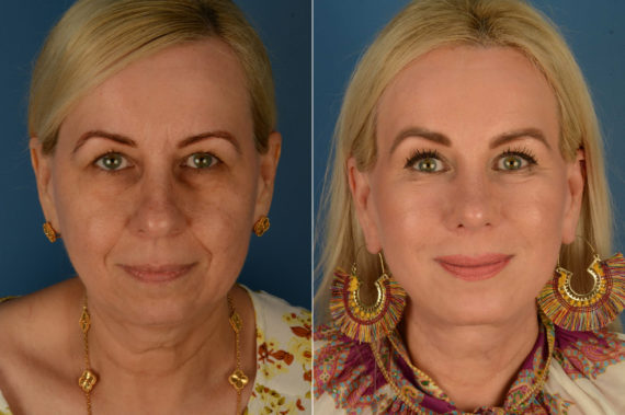 Endoscopic Facelift Before and After Photos in Naples, FL, Patient 21776