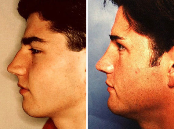 Rhinoplasty Before and After Photos in Naples, FL, Patient 8665