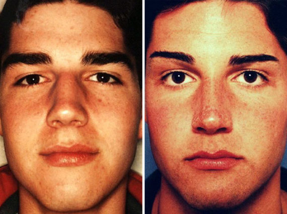 Rhinoplasty Before and After Photos in Naples, FL, Patient 8665