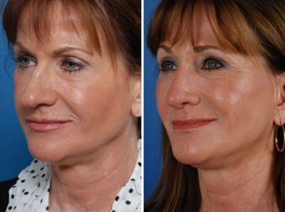 Rhinoplasty Before and After Photos in Naples, FL, Patient 8699