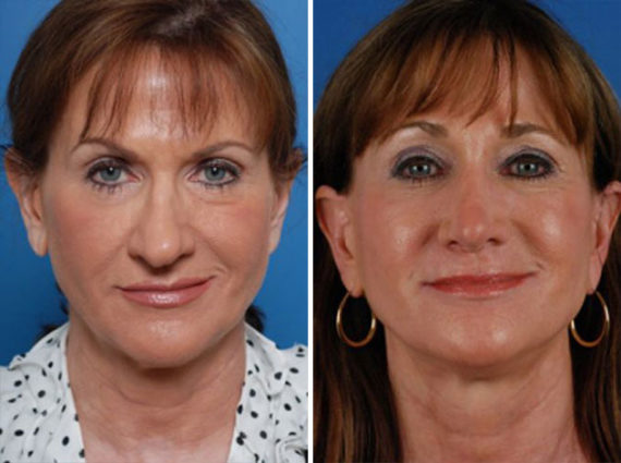 Rhinoplasty Before and After Photos in Naples, FL, Patient 8699