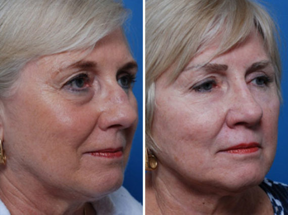 Rhinoplasty Before and After Photos in Naples, FL, Patient 8712