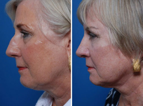 Rhinoplasty Before and After Photos in Naples, FL, Patient 8712