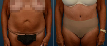 Abdominoplasty Before and After Photos in Naples, FL, Patient 21725