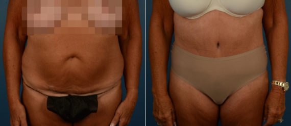 Abdominoplasty Before and After Photos in Naples, FL, Patient 21725