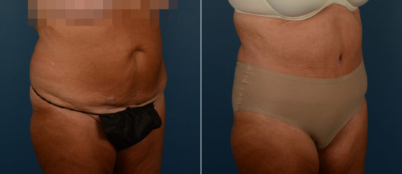 Abdominoplasty Before and After Photos in Naples, FL, Patient 21725