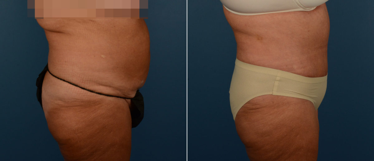Abdominoplasty Before and After Photos in Naples, FL, Patient 21725