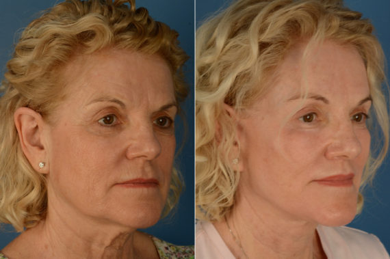 Lip Lift Before and After Photos in Naples, FL, Patient 21818