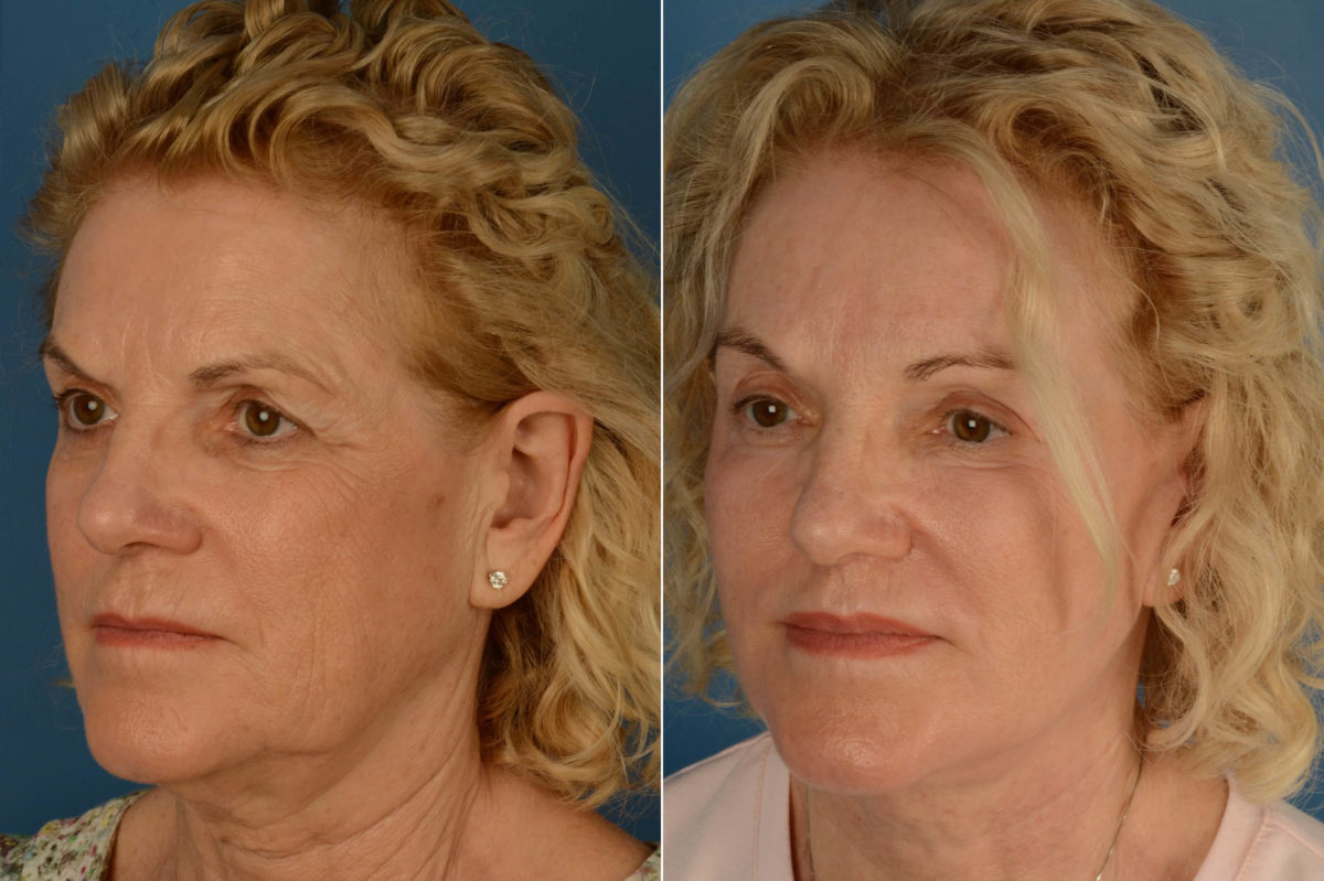 Lip Lift Before and After Photos in Naples, FL, Patient 21818