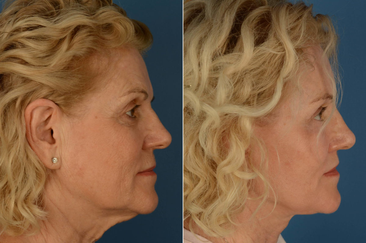 Lip Lift Before and After Photos in Naples, FL, Patient 21818