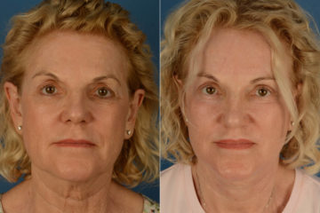 Lip Lift Before and After Photos in Naples, FL, Patient 21818