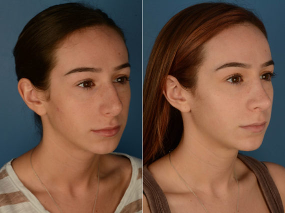 Rhinoplasty Before and After Photos in Naples, FL, Patient 21831