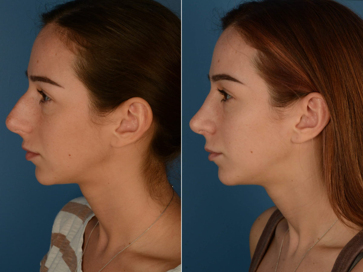 Rhinoplasty Before and After Photos in Naples, FL, Patient 21831