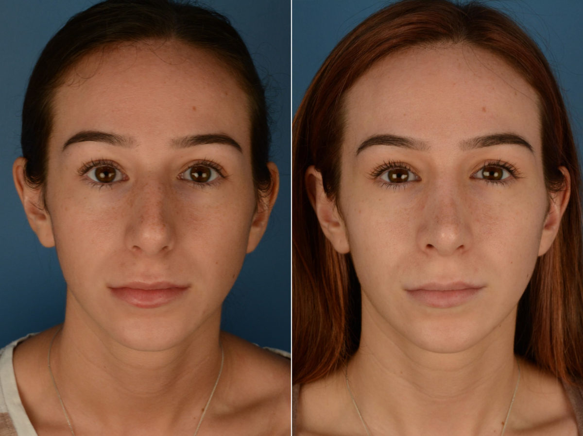 Rhinoplasty Before and After Photos in Naples, FL, Patient 21831