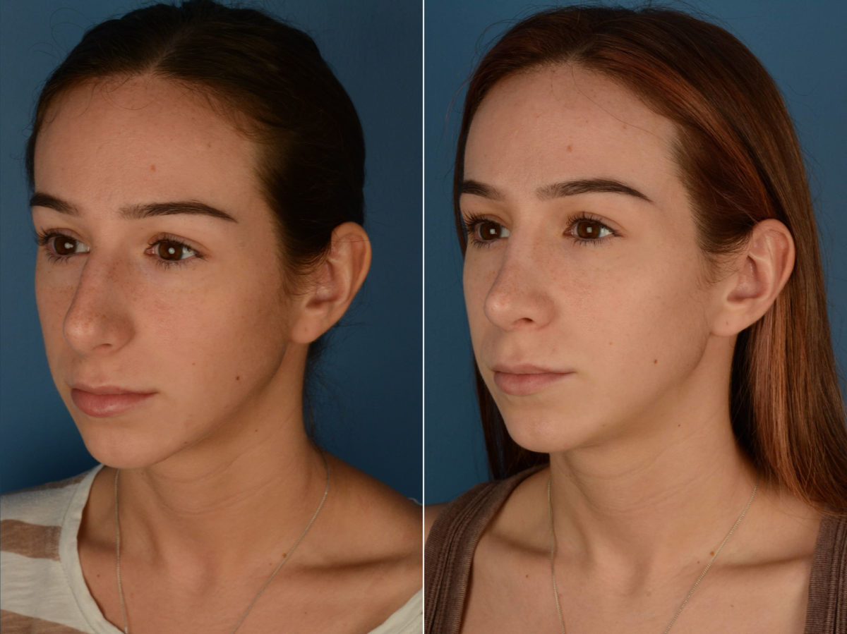 Rhinoplasty Before and After Photos in Naples, FL, Patient 21831