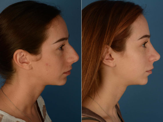 Rhinoplasty Before and After Photos in Naples, FL, Patient 21831