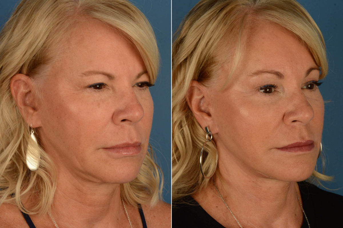 The UpLift™ Lower Face and Neck Lift Before and After Photos in Naples, FL, Patient 21847