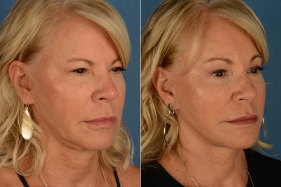 The UpLift™ Lower Face and Neck Lift Before and After Photos in Naples, FL, Patient 21847