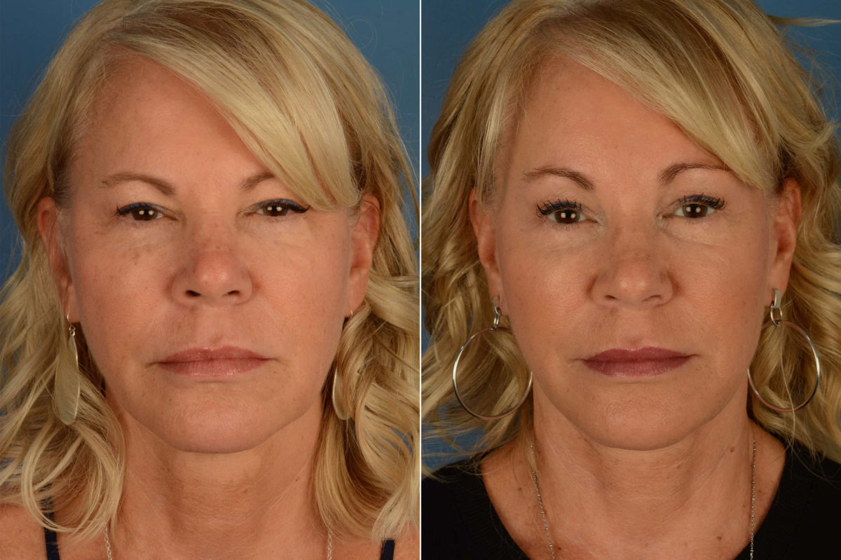 The UpLift™ Lower Face and Neck Lift Before and After Photos in Naples, FL, Patient 21847