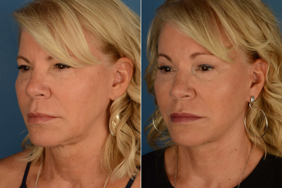The UpLift™ Lower Face and Neck Lift Before and After Photos in Naples, FL, Patient 21847